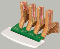 Gastro Esophageal Reflux Disease